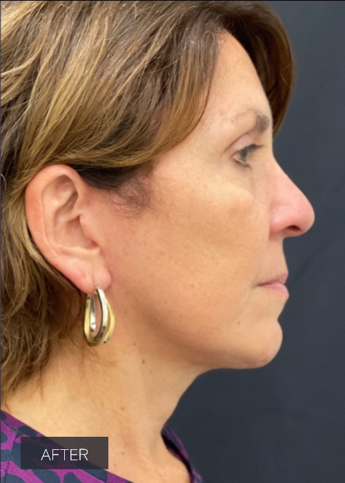 Procedure before and after - after