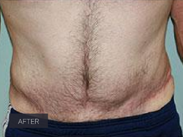 Procedure before and after - after