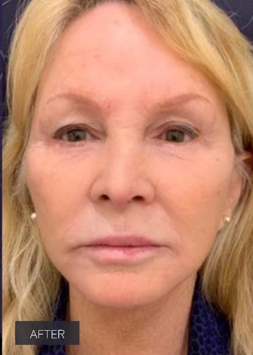 Procedure before and after - after