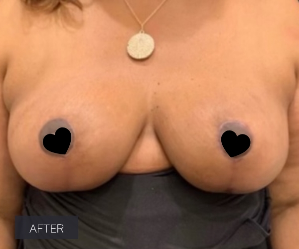 Procedure before and after - after