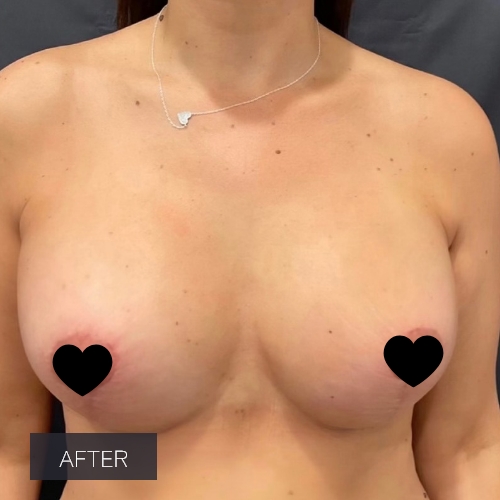 Procedure before and after - after