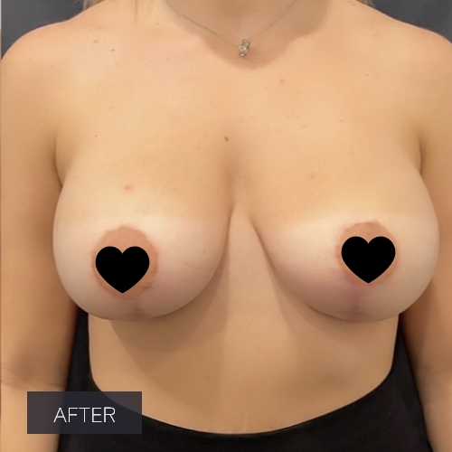 Procedure before and after - after