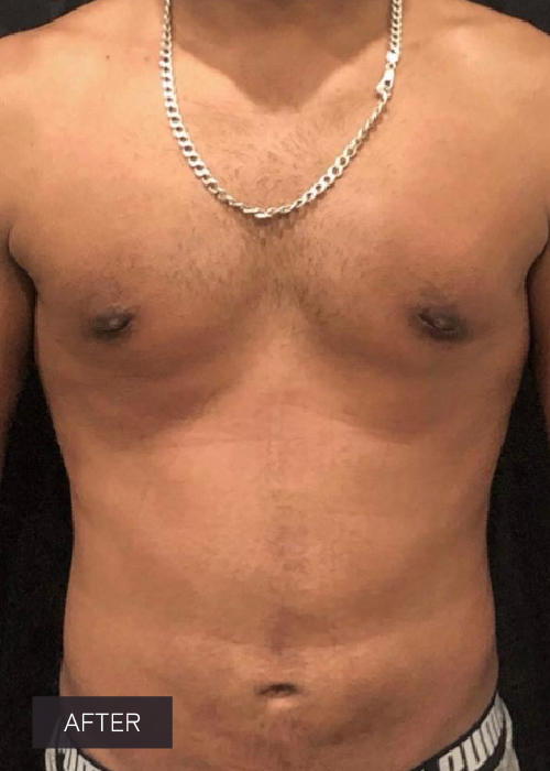 Procedure before and after - after