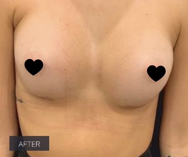 Procedure before and after - after