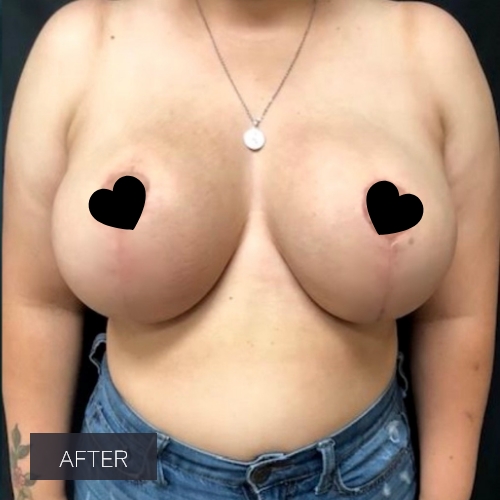 Procedure before and after - after
