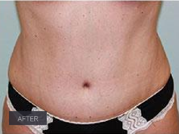 Procedure before and after - after