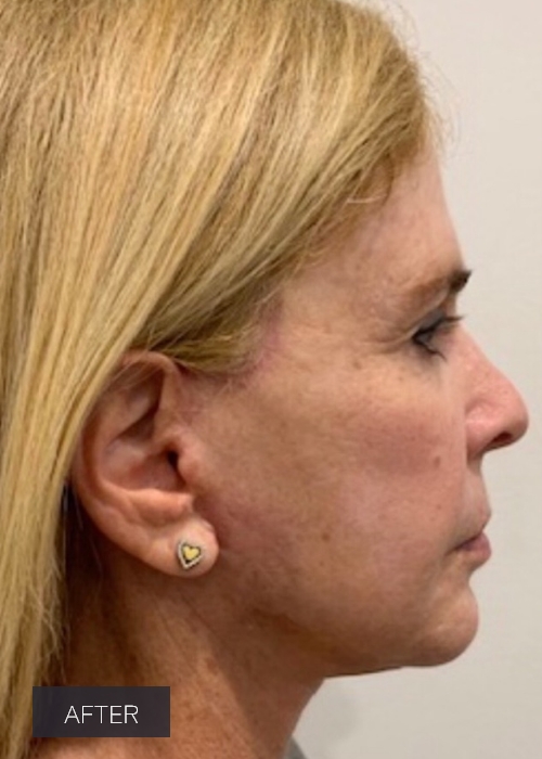 Procedure before and after - after