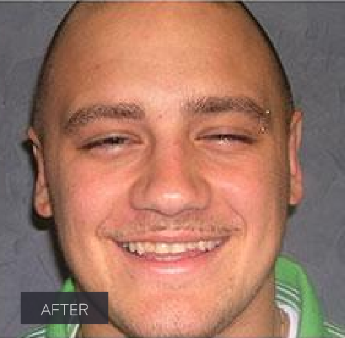 Procedure before and after - after