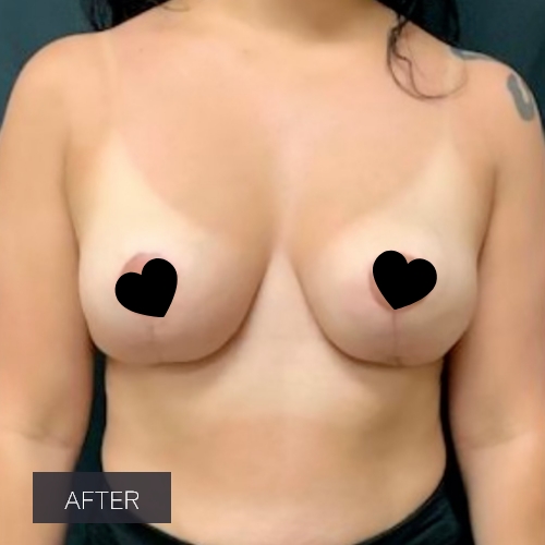 Procedure before and after - after