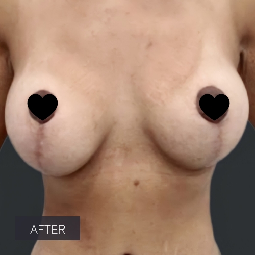 Procedure before and after - after