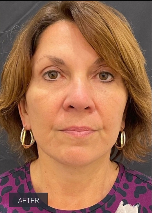 Procedure before and after - after