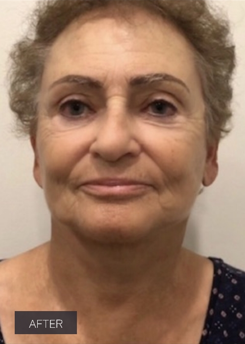 Procedure before and after - after