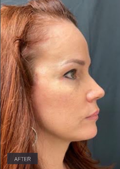 Procedure before and after - after