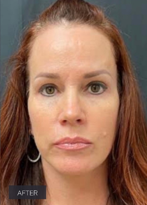 Procedure before and after - after