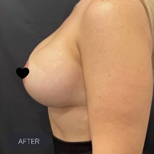 Procedure before and after - after