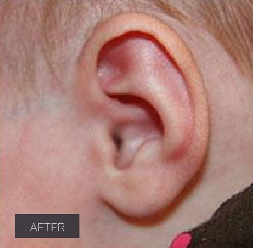 Procedure before and after - after
