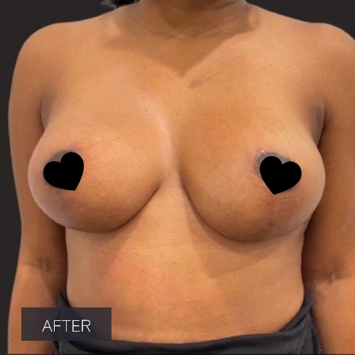 Procedure before and after - after