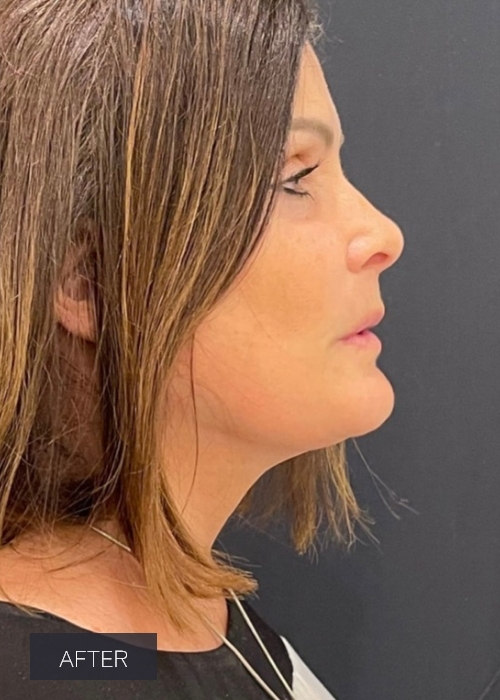 Procedure before and after - after
