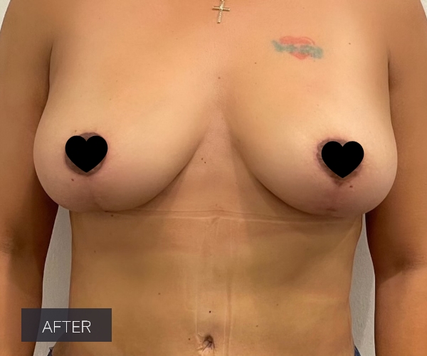 Procedure before and after - after