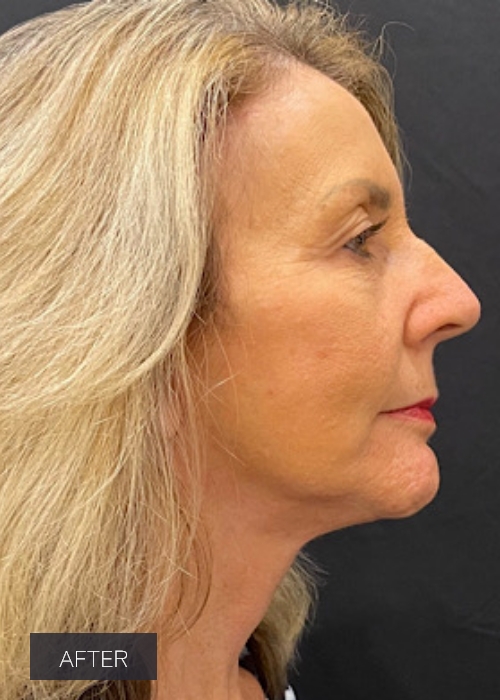 Procedure before and after - after