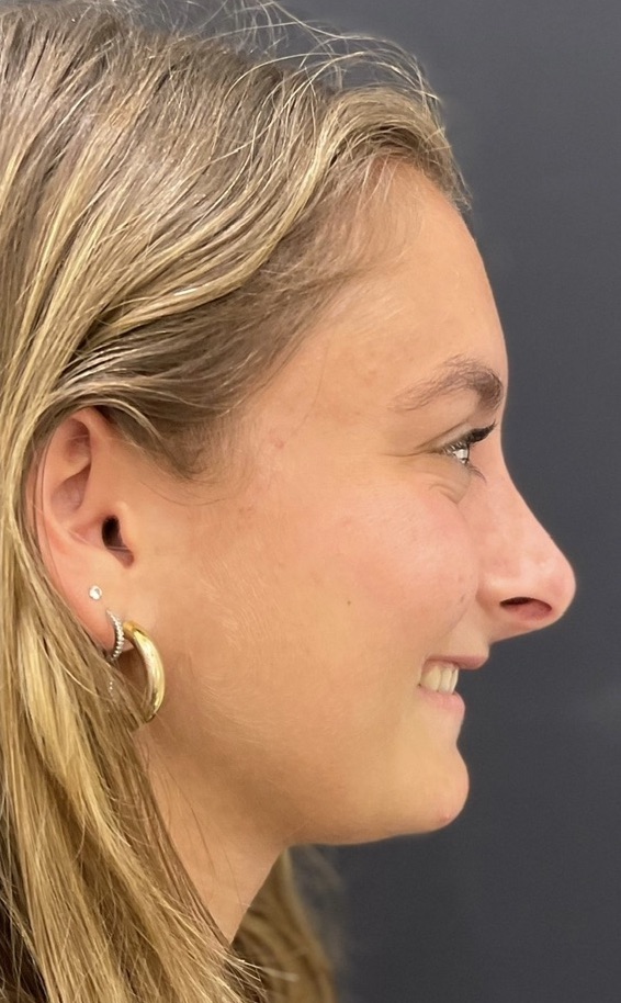 Procedure before and after - after