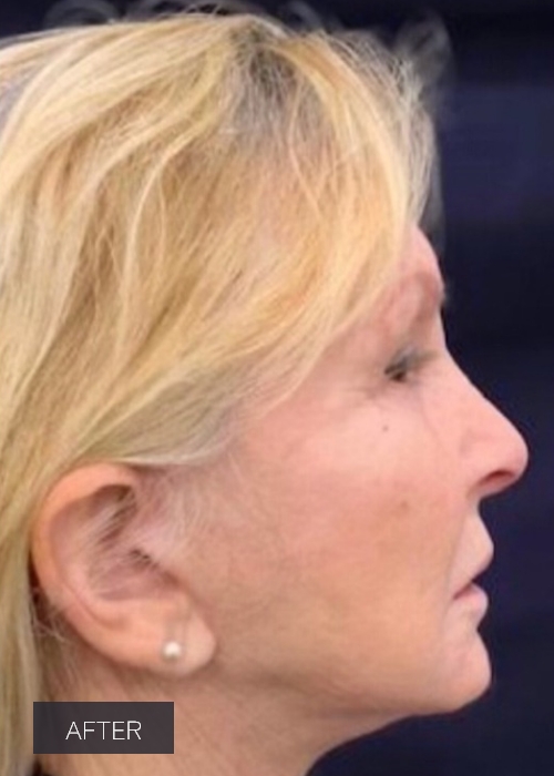 Procedure before and after - after