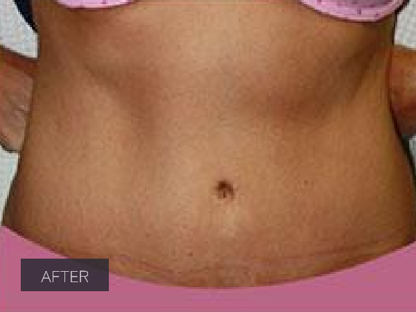 Procedure before and after - after
