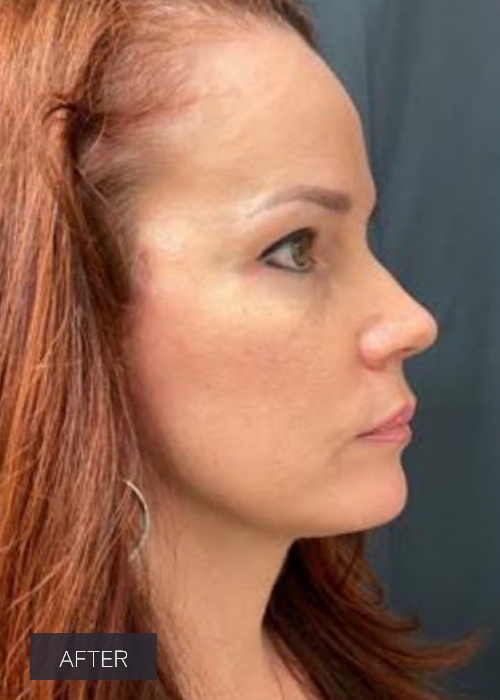 Procedure before and after - after