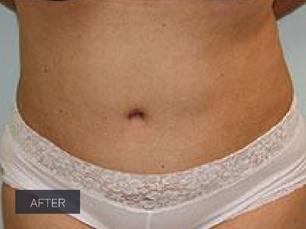 Procedure before and after - after