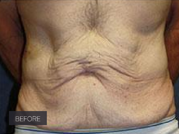 Procedure before and after - before