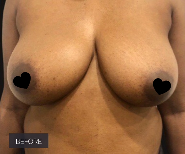 Procedure before and after - before