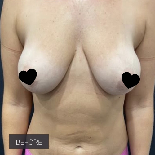 Procedure before and after - before