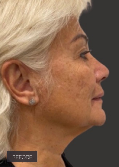 Procedure before and after - before