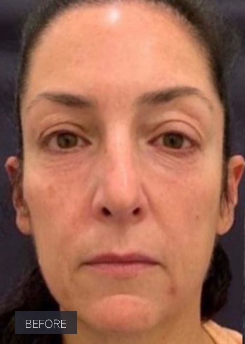 Procedure before and after - before