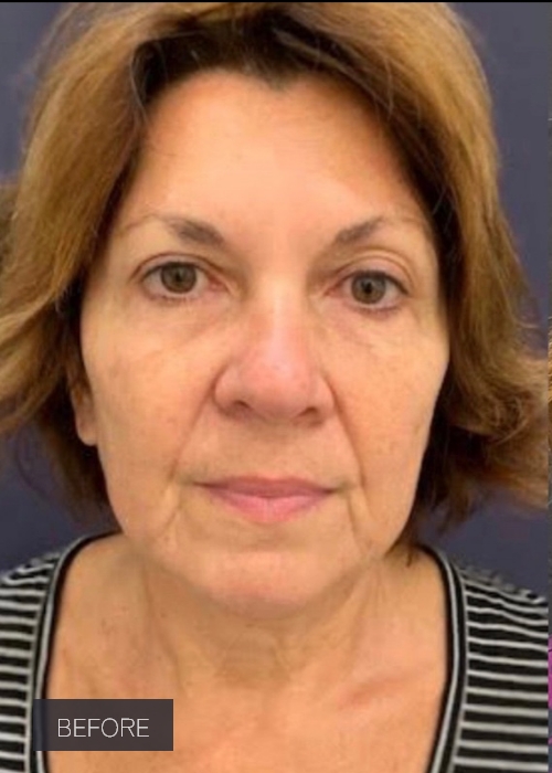 Procedure before and after - before