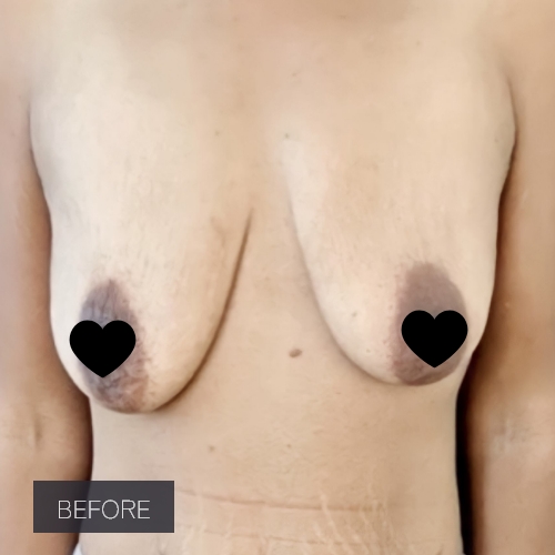 Procedure before and after - before