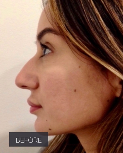 Procedure before and after - before