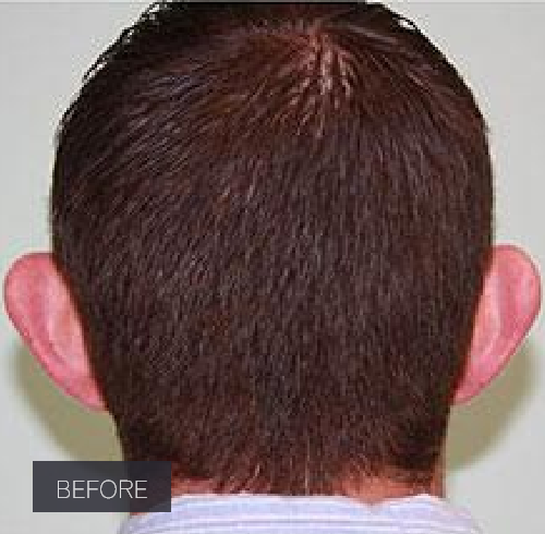 Procedure before and after - before