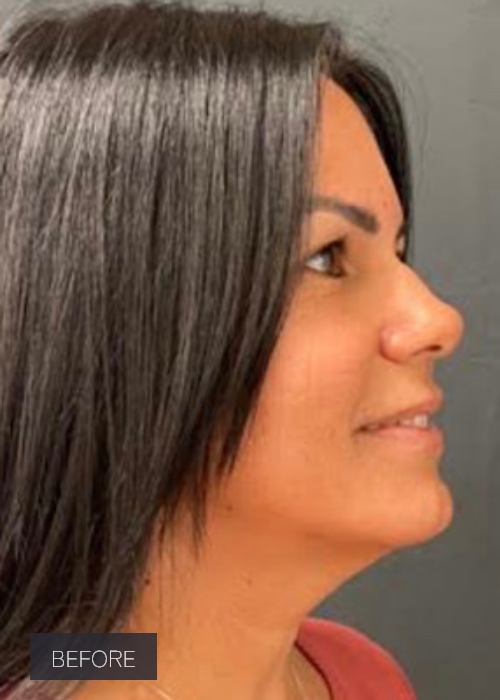 Procedure before and after - before