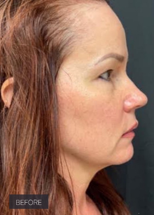 Procedure before and after - before
