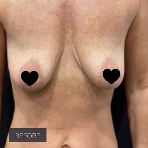 Procedure before and after - before