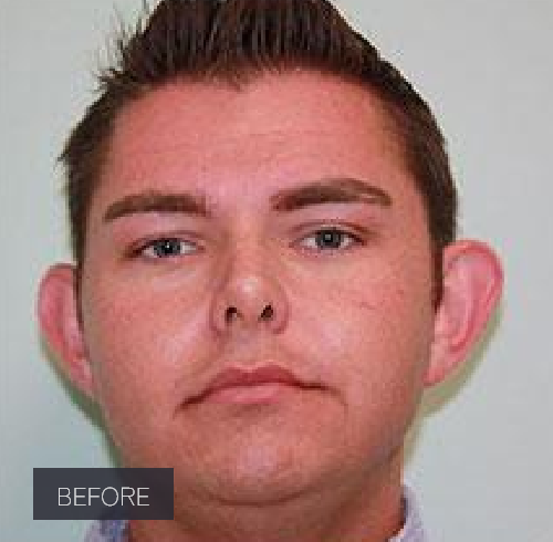 Procedure before and after - before