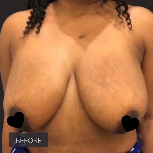 Procedure before and after - before