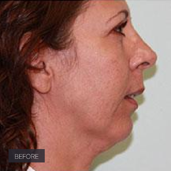 Procedure before and after - before
