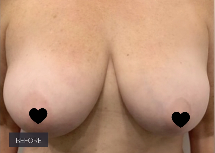 Procedure before and after - before