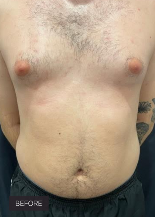 Procedure before and after - before