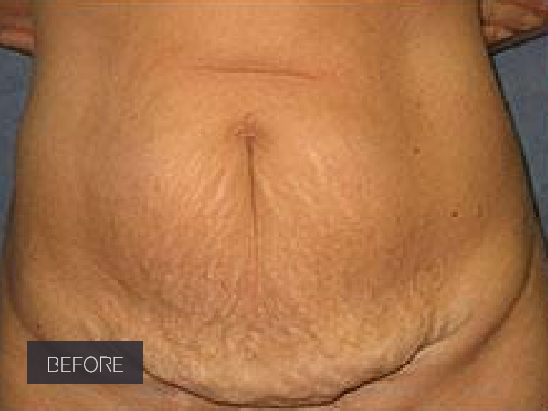 Procedure before and after - before