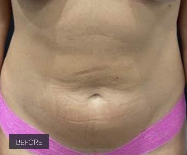 Procedure before and after - before