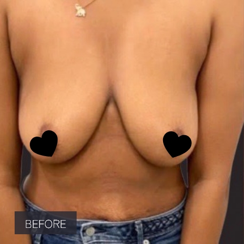 Procedure before and after - before
