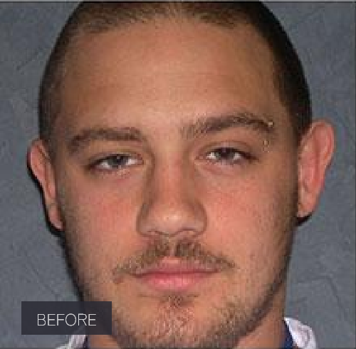 Procedure before and after - before